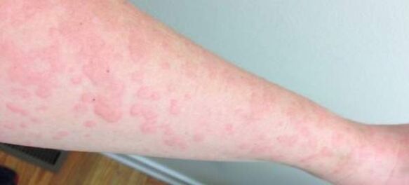 A bőrallergia a paraziták jelenlétét jelzi a szervezetben